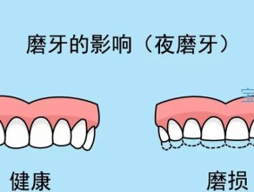 磨牙最好的解决方法是什么？如何有效缓解夜间磨牙问题？