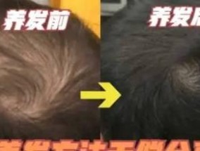 头发掉得太严重怎么办？自救方法有哪些？