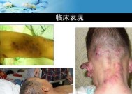 被蜜蜂蛰伤了怎么办？急救秘籍告诉你正确处理方法