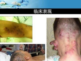 被蜜蜂蛰伤了怎么办？急救秘籍告诉你正确处理方法