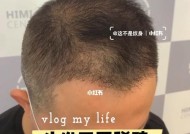 17岁头发稀疏恢复方法（有效改善青少年头发稀疏问题）