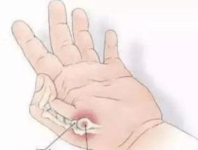 鼠标手的最佳治疗方法是什么？如何快速缓解症状？