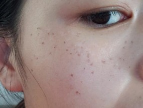 肤色不均是什么原因造成的？如何有效改善？