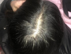 17岁头发稀疏怎么办？有效恢复方法有哪些？