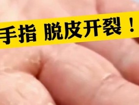 冬天手部开裂是什么原因？如何预防和治疗？