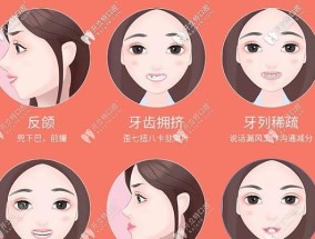 改善龅牙小妙招？有效方法有哪些？