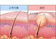 青春痘怎么快速消除？有效窍门大揭秘！