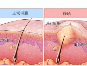 青春痘怎么快速消除？有效窍门大揭秘！