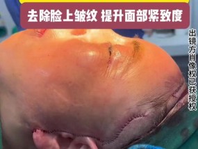 改善皮肤松弛最好的方法是什么？有效改善皮肤松弛的秘诀有哪些？