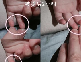 水泡出现怎么办？快速消除水泡的有效方法是什么？