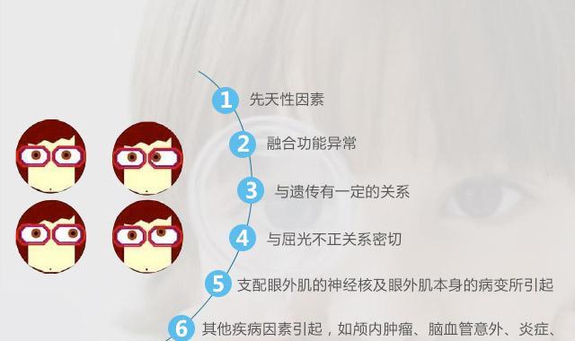 探究斜视的原因及预防方法（斜视症状）  第1张