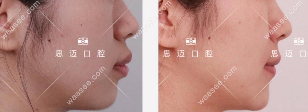改善龅牙小妙招？有效方法有哪些？  第3张