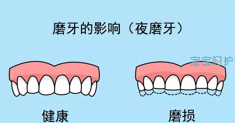 磨牙最好的解决方法是什么？如何有效缓解夜间磨牙问题？  第1张