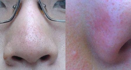酒糟鼻是如何形成的？了解其形成原因有助于预防和治疗？  第2张