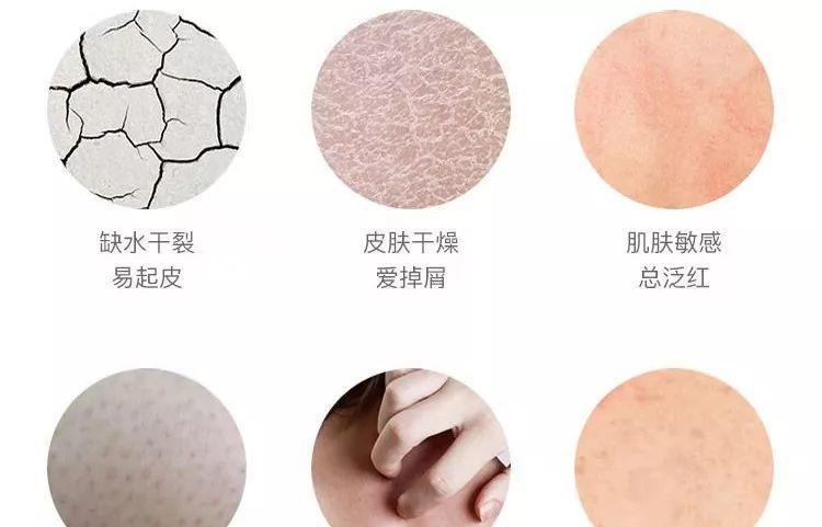 全身皮肤干燥脱皮掉屑怎么办？有效解决方法有哪些？  第1张