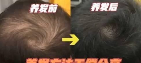 头发掉得太严重怎么办？自救方法有哪些？  第1张