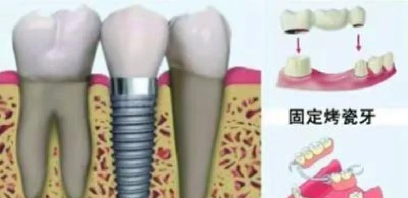 拔牙后镶牙的最佳时间是什么时候？多久进行修复最合适？  第2张
