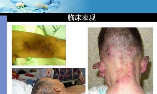 被蜜蜂蛰伤了怎么办？急救秘籍告诉你正确处理方法  第1张