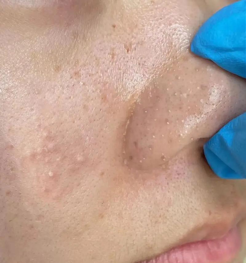 鼻子上的黑头怎么去掉？试试这些简单有效的小妙招吧！  第3张