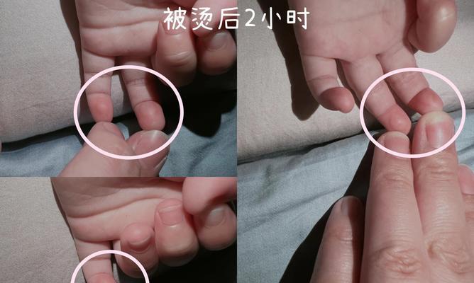 水泡出现怎么办？快速消除水泡的有效方法是什么？  第1张
