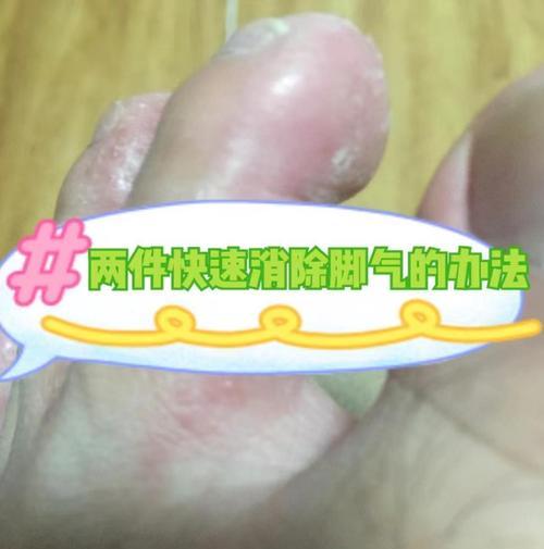 水泡出现怎么办？快速消除水泡的有效方法是什么？  第3张
