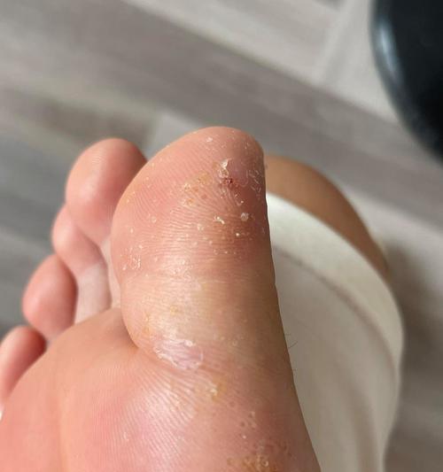 水泡出现怎么办？快速消除水泡的有效方法是什么？  第2张