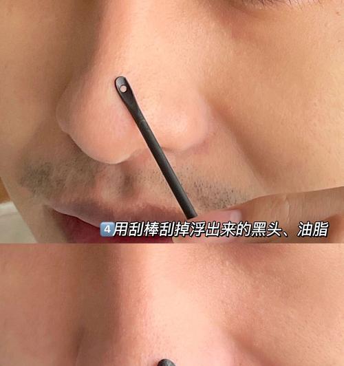 正确去黑头的方法是什么？如何避免常见的去黑头误区？  第1张