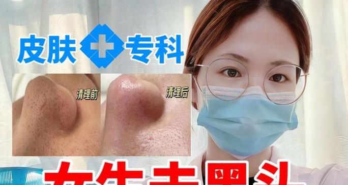 正确去黑头的方法是什么？如何避免常见的去黑头误区？  第2张
