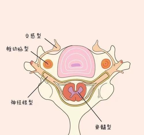 颈椎压迫神经最好的治疗方法是什么？如何有效缓解症状？  第3张